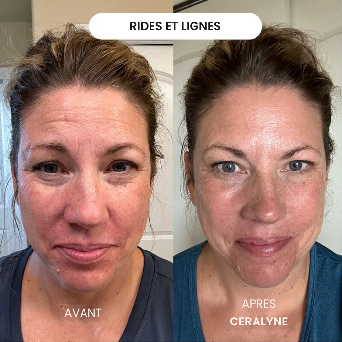 Transformez une peau terne avec le système de micro-infusion anti-âge