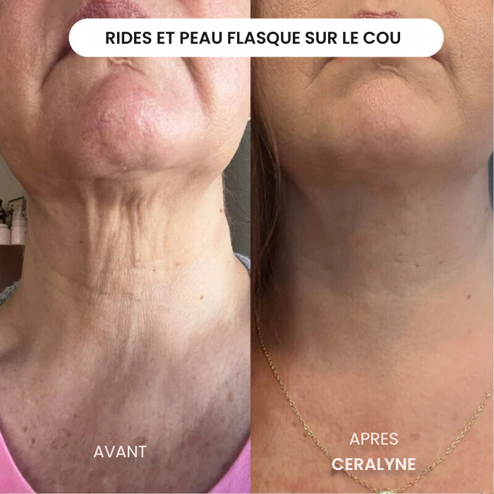Transformez une peau terne avec le système de micro-infusion anti-âge