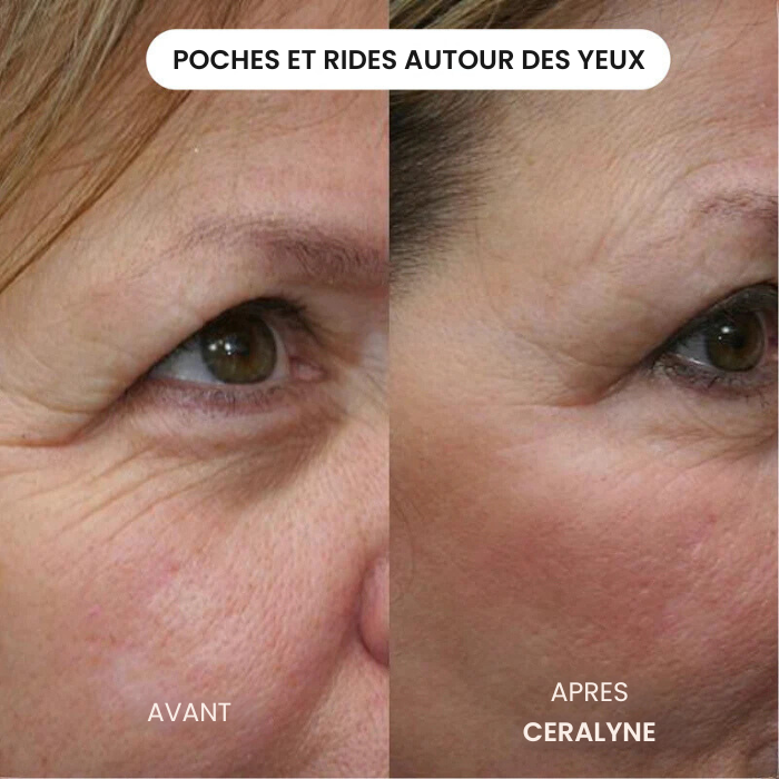 Transformez une peau terne avec le système de micro-infusion anti-âge