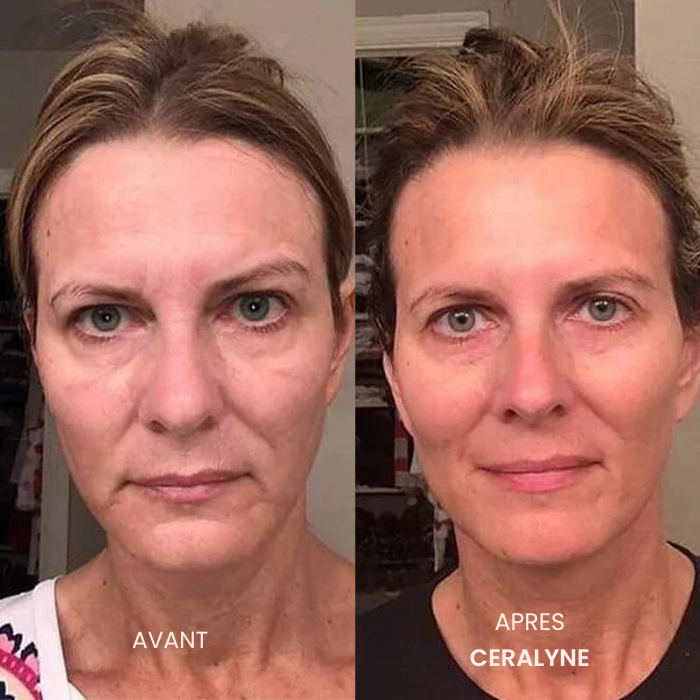 Transformez une peau terne avec le système de micro-infusion anti-âge