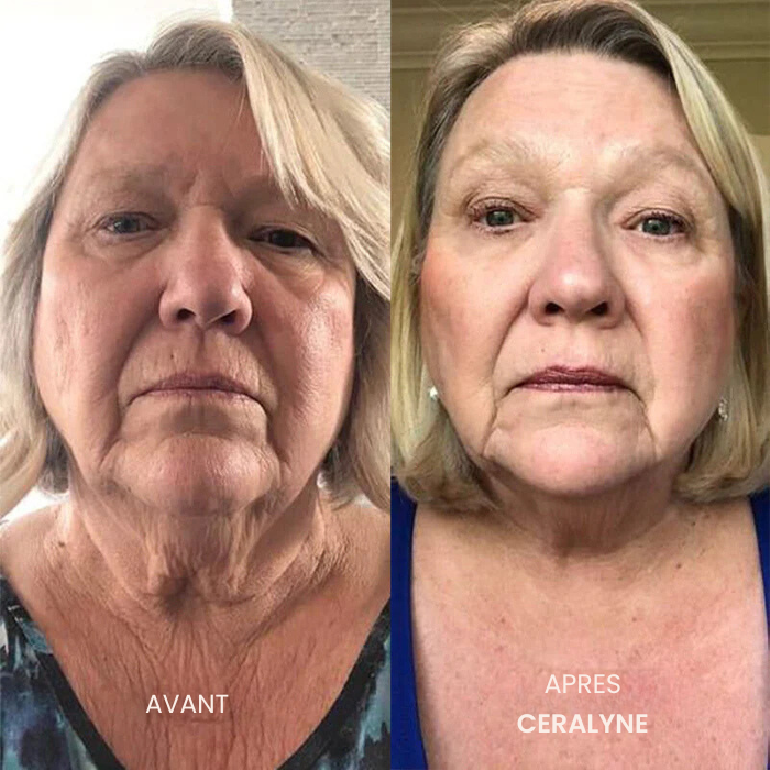 Transformez une peau terne avec le système de micro-infusion anti-âge
