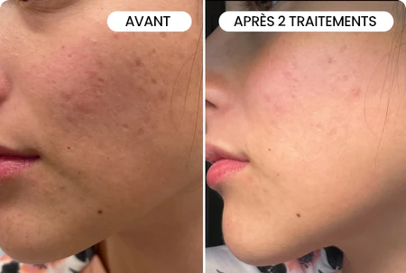 Transformez une peau terne avec le système de micro-infusion anti-âge