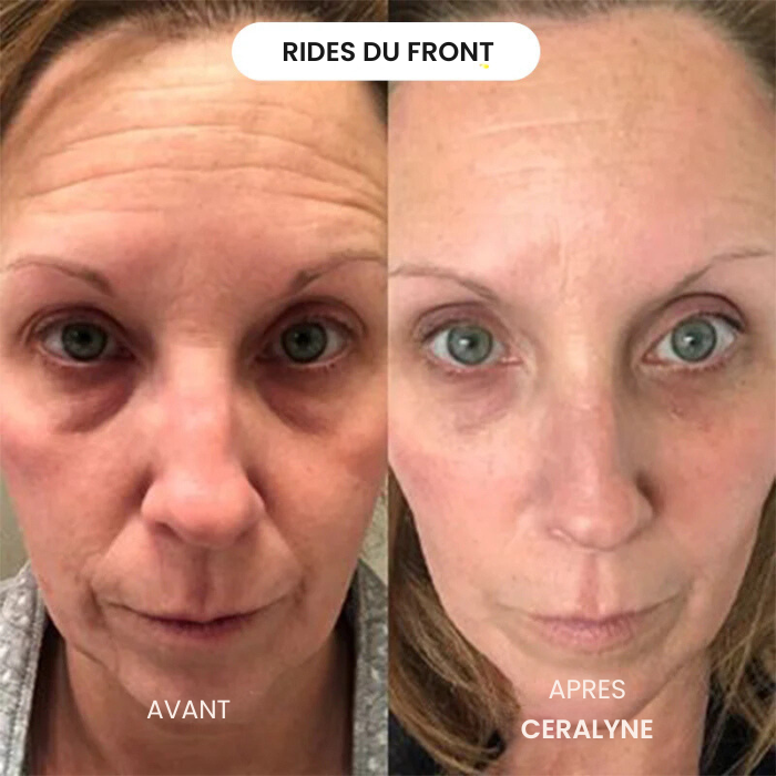 Transformez une peau terne avec le système de micro-infusion anti-âge