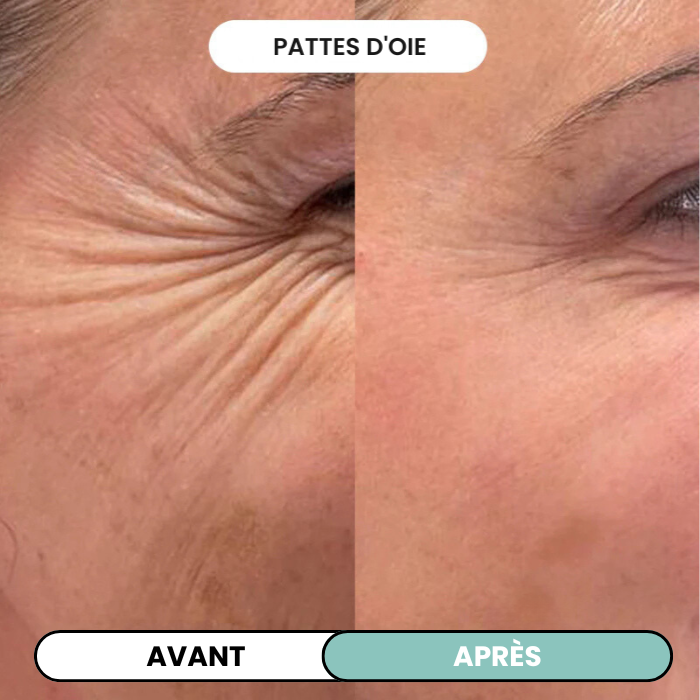 Transformez une peau terne avec le système de micro-infusion anti-âge