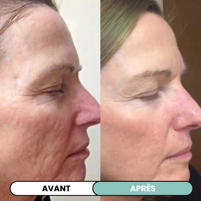 Transformez une peau terne avec le système de micro-infusion anti-âge
