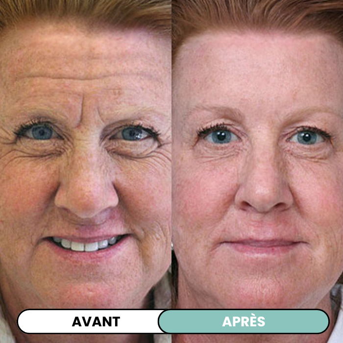 Transformez une peau terne avec le système de micro-infusion anti-âge