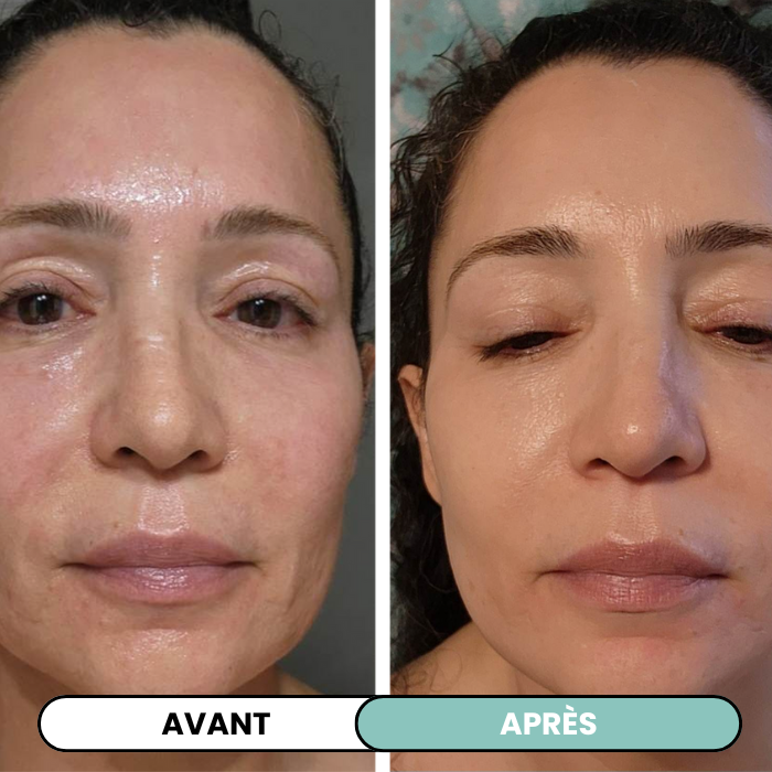 Transformez une peau terne avec le système de micro-infusion anti-âge