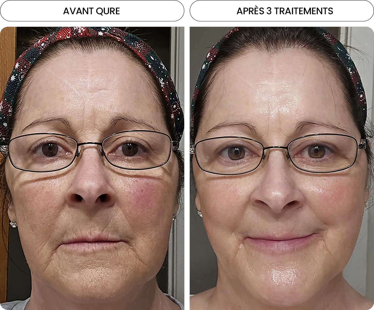 Transformez une peau terne avec le système de micro-infusion anti-âge