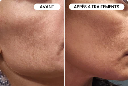 Transformez une peau terne avec le système de micro-infusion anti-âge