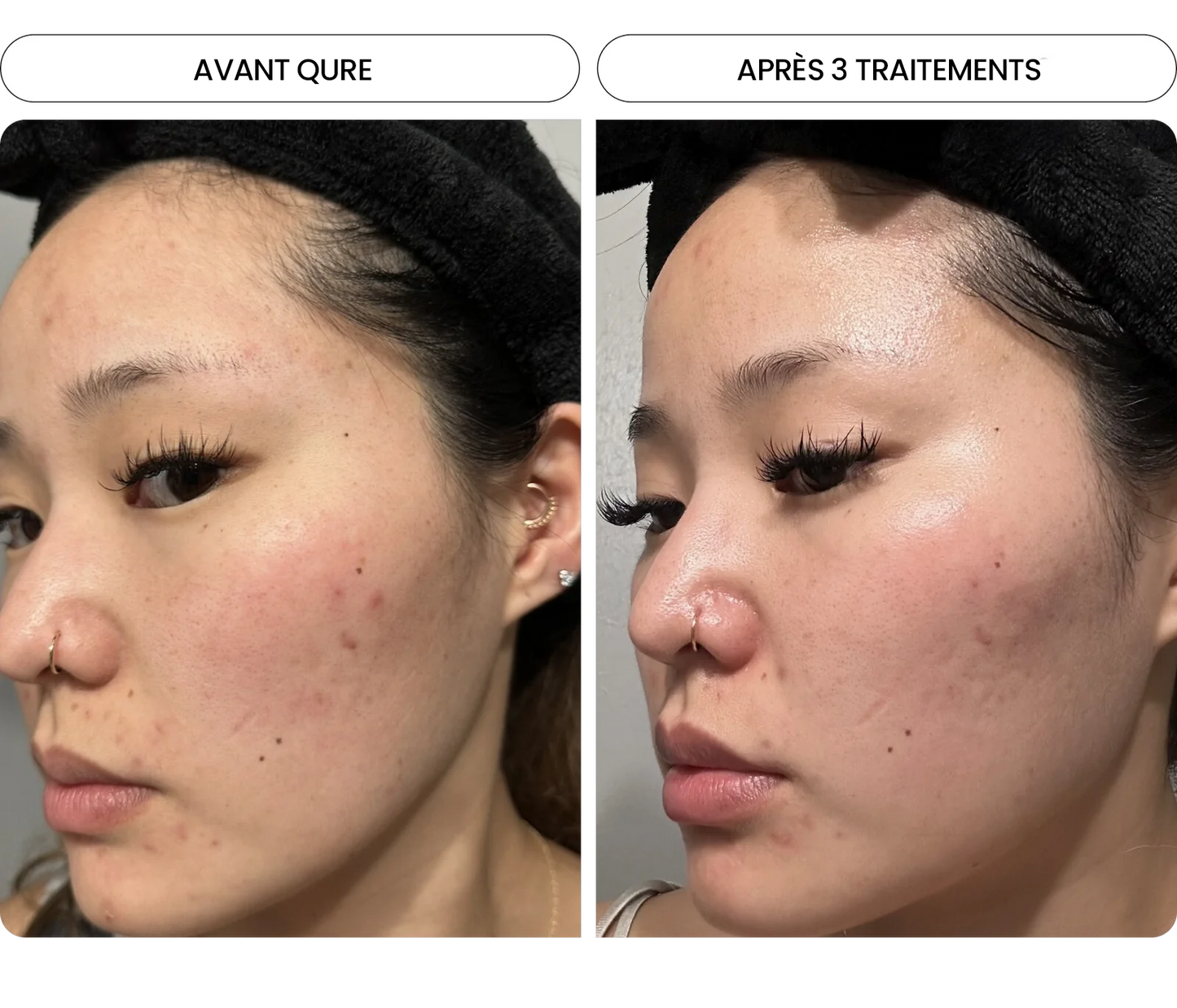 Transformez une peau terne avec le système de micro-infusion anti-âge