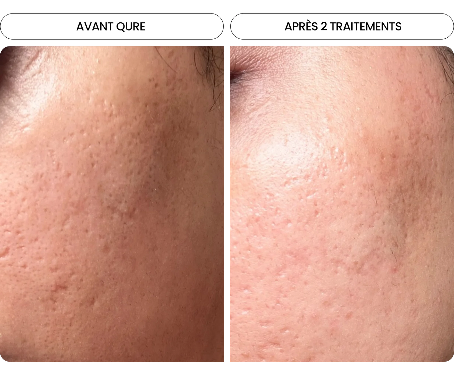 Transformez une peau terne avec le système de micro-infusion anti-âge