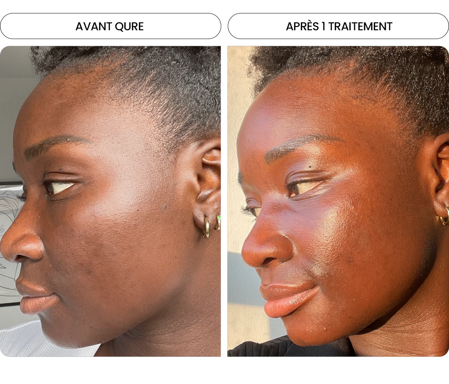 Transformez une peau terne avec le système de micro-infusion anti-âge