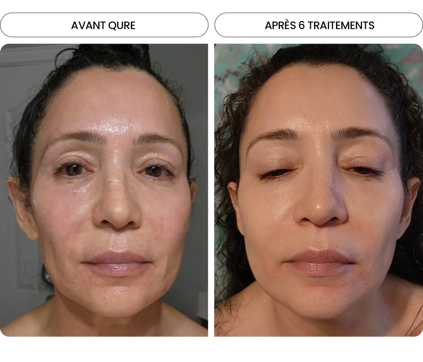 Transformez une peau terne avec le système de micro-infusion anti-âge