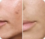 Transformez une peau terne avec le système de micro-infusion anti-âge